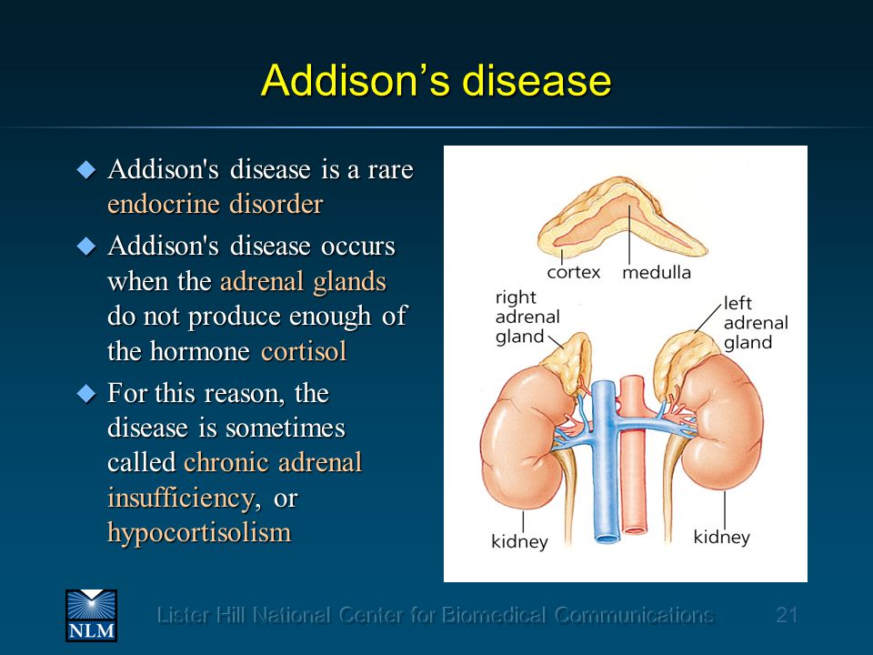 Addison s disease hypocortisolism